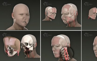 Zigomi, mascella e naso, in Spagna primo trapianto facciale